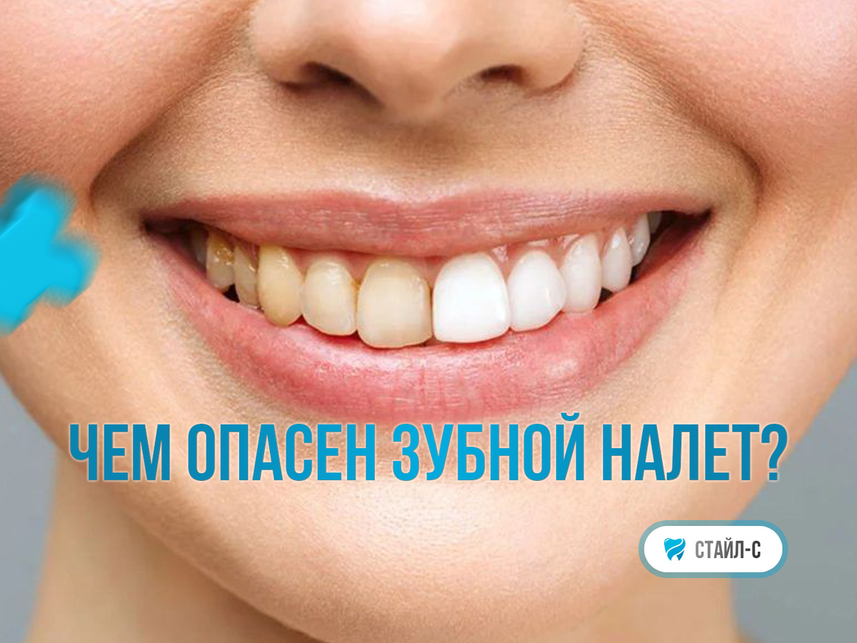 Опасности зубного налета: что нужно знать каждому